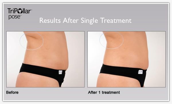 TriPollar POSE clinical results: Body skin tightening.