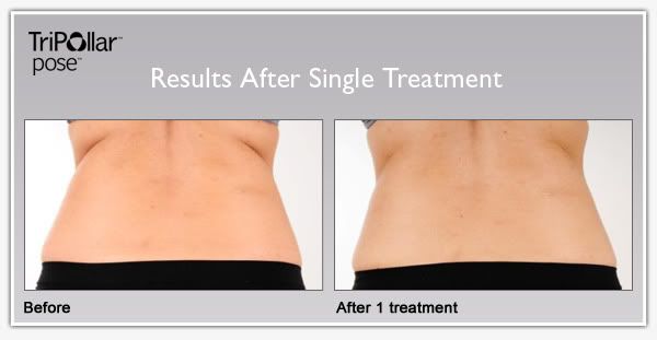 TriPollar POSE clinical results: before and after single treatment Body skin tightening
