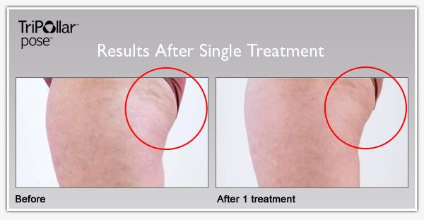 TriPollar POSE clinical results: Cellulite reduction and sagging ass skin shrinking