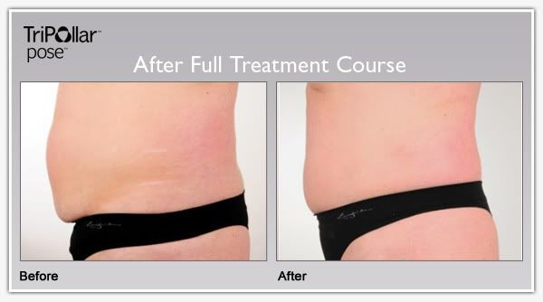 TriPollar POSE clinical results: Non invasive liposuction results in tummy circumference reduction.
