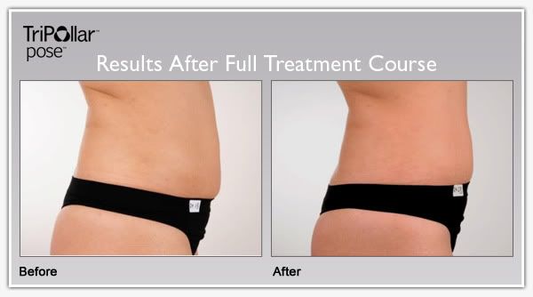 TriPollar POSE clinical results: tummy circumference reduction.
