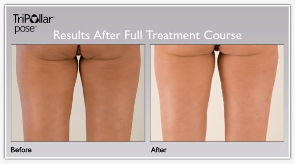 TriPollar POSE clinical results: buttocks lifting and sagging skin tightening